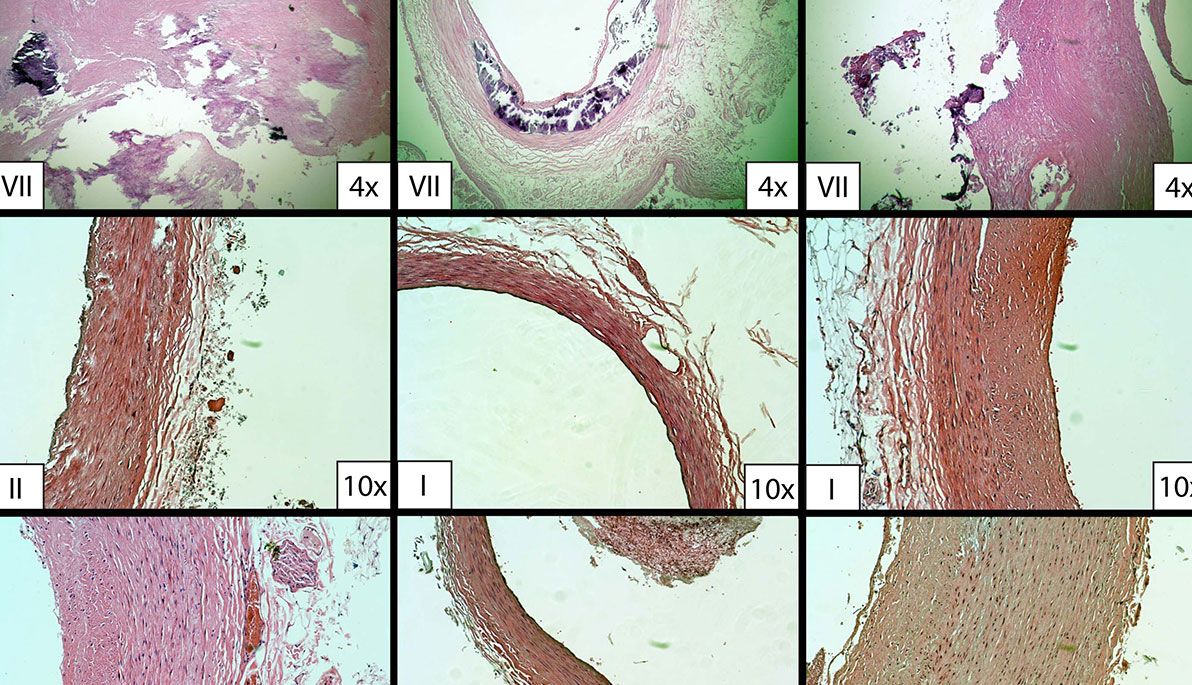 Researchers Find a Way to the Heart of Heart Disease