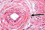 One Pan Chicken. The onion reminded Segelnick of primary sclerosing cholangitis—a disease that slowly damages the bile ducts.